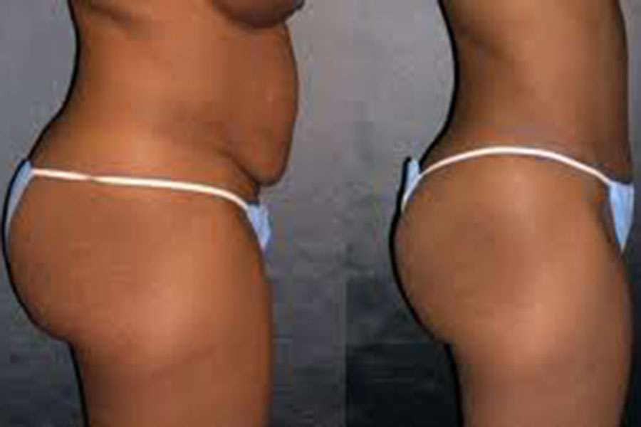 6 Signs of Bad Liposuction and How to Fix Them