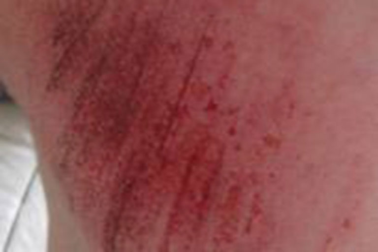 abrasions-lacer-img