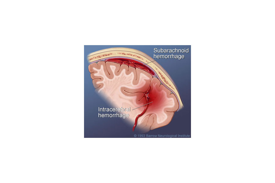 What Are Three Main Kinds Of Brain Bleeding Godoy Medical Forensics