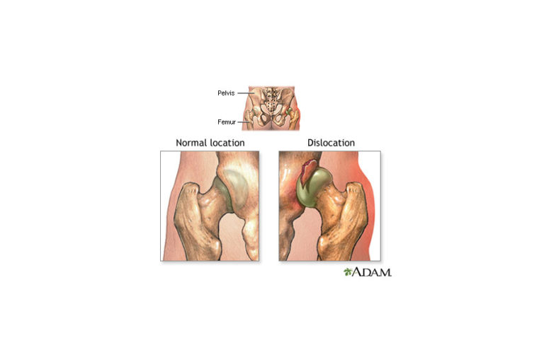 hip-dislocation-img