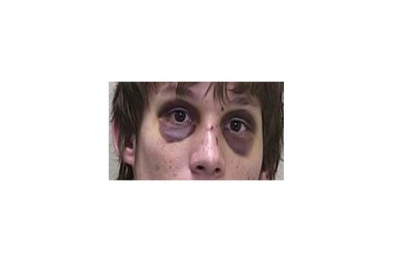 Bilateral_periorbital_ecchymosis_raccoon_eyes